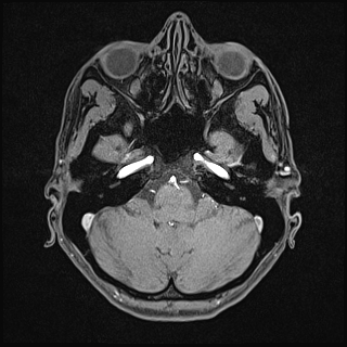 File:Basilar artery perforator aneurysm (Radiopaedia 82455-97733 Axial T1 fat sat 31).jpg