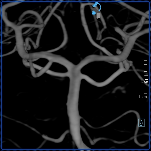Basilar artery perforator aneurysm (Radiopaedia 82455-99524 3D Left VA 43).jpg