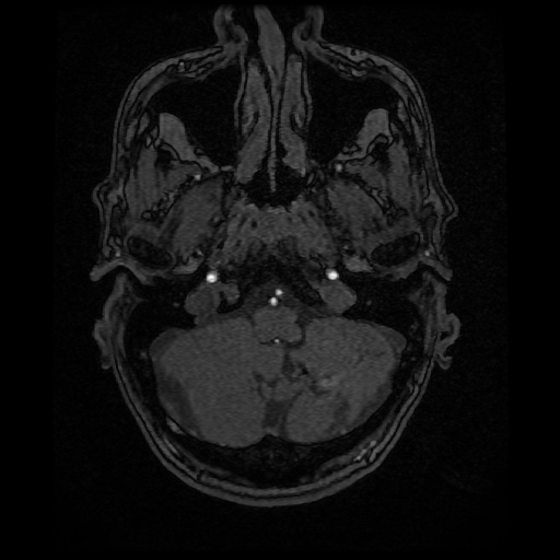Basilar top and left middle cerebral artery aneurysm (Radiopaedia 61965-70031 Axial MRA 15).jpg