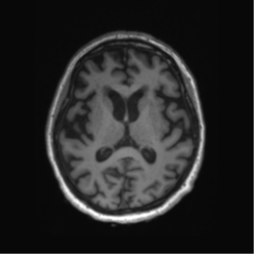 File:Behavioral variant frontotemporal dementia and late onset schizophrenia (Radiopaedia 52197-58083 Axial T1 46).png