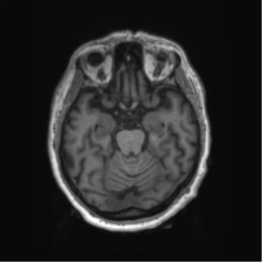 File:Behavioral variant frontotemporal dementia and late onset schizophrenia (Radiopaedia 52197-58083 Axial T1 70).png