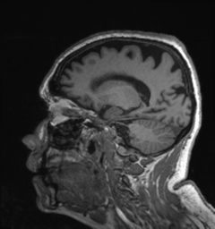 Behavioral variant frontotemporal dementia and late onset schizophrenia (Radiopaedia 52197-58083 Sagittal T1 31).png