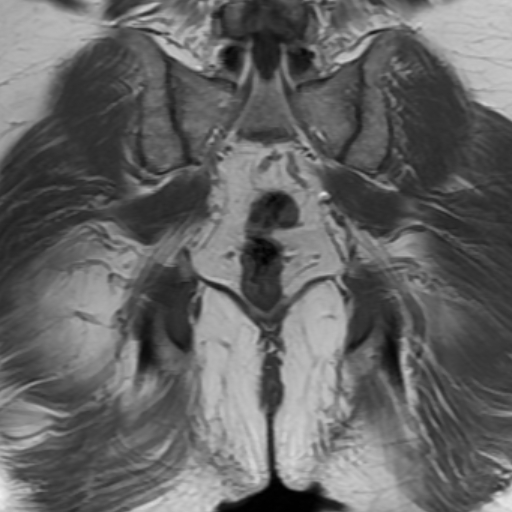 File:Benign prostatic nodular hyperplasia (Radiopaedia 16917-16634 Coronal T1 17).jpg