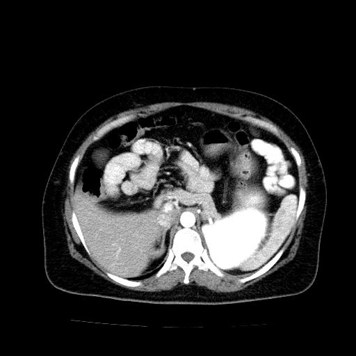 Benign spindle cell tumor - abdominopelvic (Radiopaedia 61300-69212 A 16).jpg