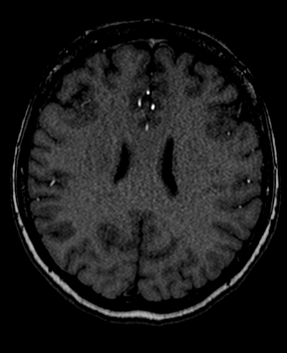 Berry aneurysm of the terminal internal carotid artery (Radiopaedia 88286-104918 Axial TOF 153).jpg
