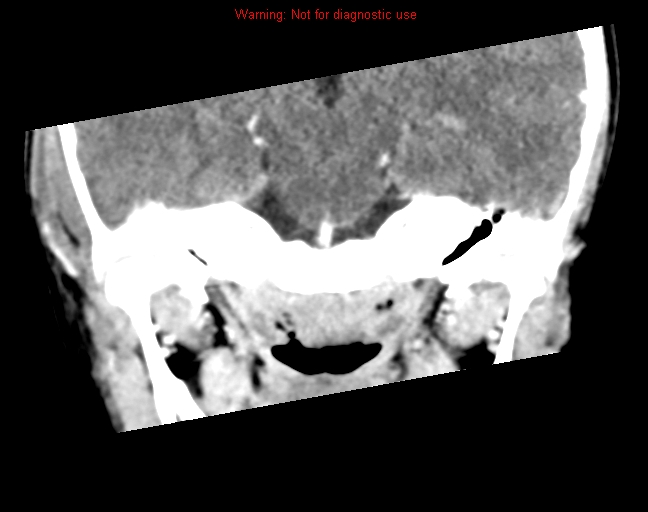 File:Bezold abscess (Radiopaedia 21645-21605 C+ arterial phase 7).jpg