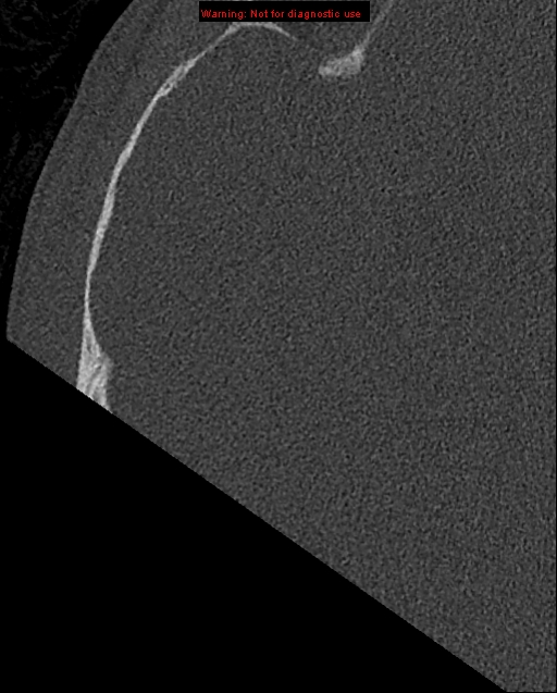 Bezold abscess (Radiopaedia 21645-21605 bone window 6).jpg