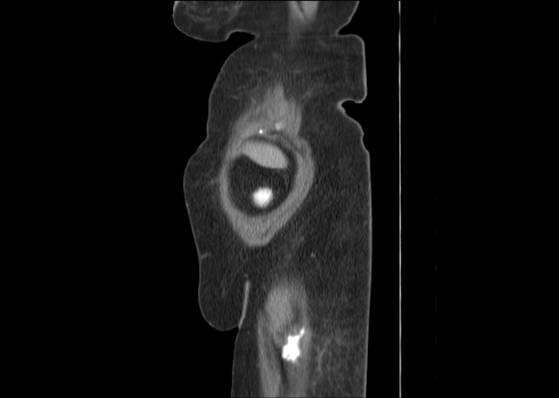 Bicameral celiacomesenteric aneurysm (Radiopaedia 55766-62327 B 5).jpg