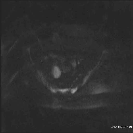File:Bicornuate uterus (MRI) (Radiopaedia 49206-54297 Axial 104).jpg