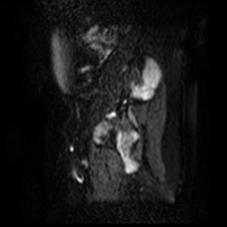 File:Bicornuate uterus (Radiopaedia 51676-57472 Sagittal DWI 23).jpg