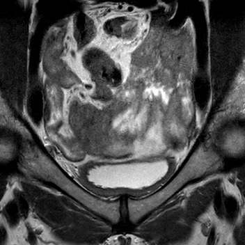 File:Bicornuate uterus (Radiopaedia 61974-70046 Coronal T2 1).jpg