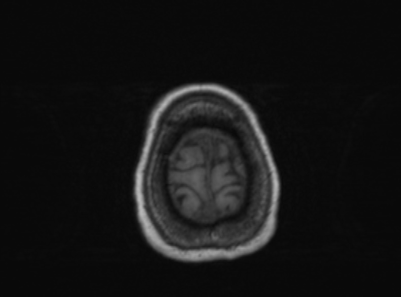 Bilateral PCA territory infarction - different ages (Radiopaedia 46200-51784 Axial T1 122).jpg