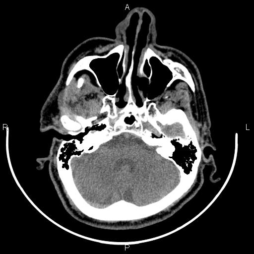 Bilateral Warthin tumors (Radiopaedia 84034-99263 Axial non-contrast 5).jpg