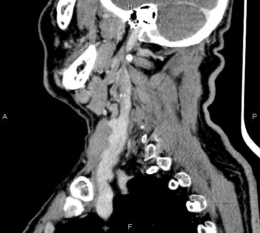 Bilateral Warthin tumors (Radiopaedia 84034-99263 D 30).jpg
