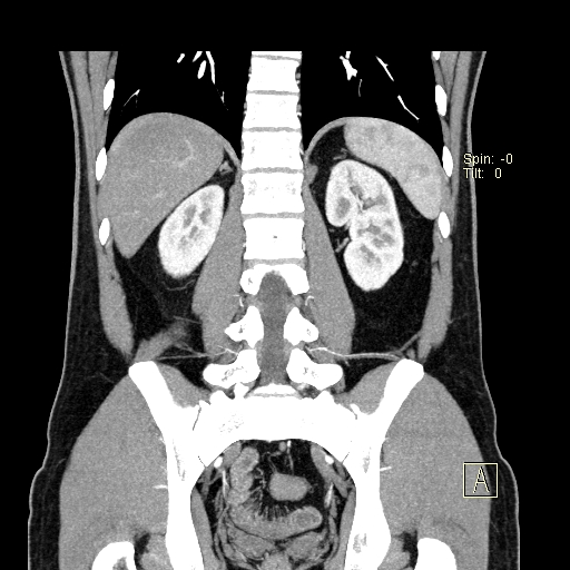 File:Bilateral accessory renal arteries with mild pelvi-ureteric junction (PUJ) obstruction (Radiopaedia 66357-75596 B 41).jpg