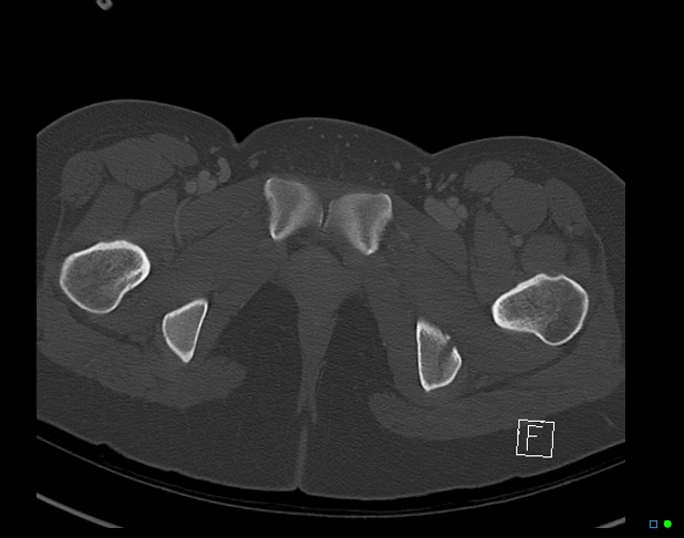 File:Bilateral acetabular fractures (Radiopaedia 79272-92308 Axial bone window 57).jpg