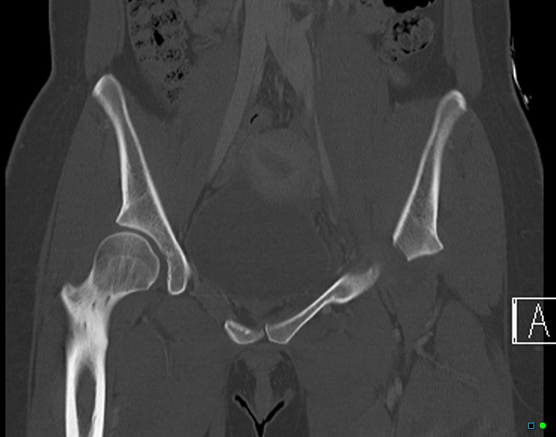 File:Bilateral acetabular fractures (Radiopaedia 79272-92308 Coronal bone window 14).jpg