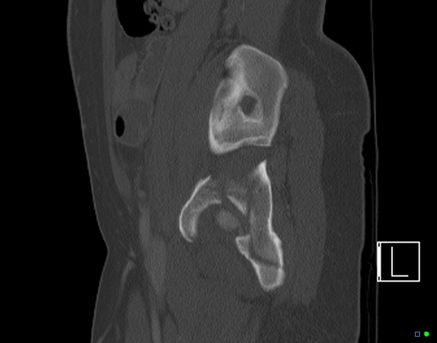 Bilateral acetabular fractures (Radiopaedia 79272-92308 Sagittal bone window 64).jpg