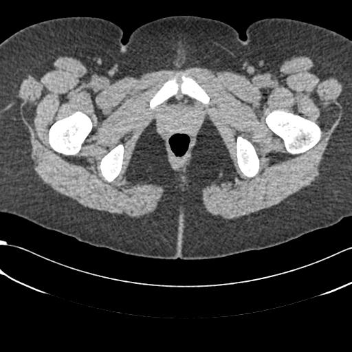 Bilateral acetabular protrusion with pincer type femoro-acetabular impingement (Radiopaedia 30134-30733 AXIAL SOFT THIN 80).jpg