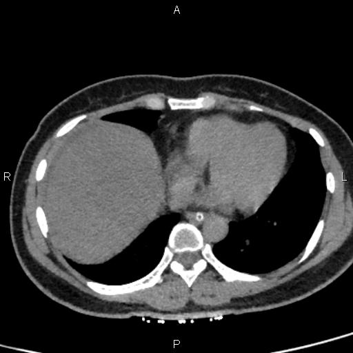 File:Bilateral adrenal gland hyperenhancement in pancreatitis (Radiopaedia 86642-102753 Axial non-contrast 6).jpg