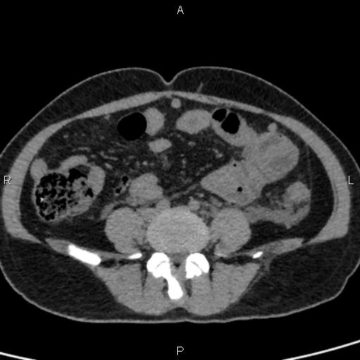 Bilateral adrenal gland hyperenhancement in pancreatitis (Radiopaedia 86642-102753 Axial non-contrast 74).jpg