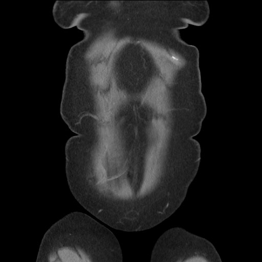 Bilateral adrenal granulocytic sarcomas (chloromas) (Radiopaedia 78375-91007 B 17).jpg
