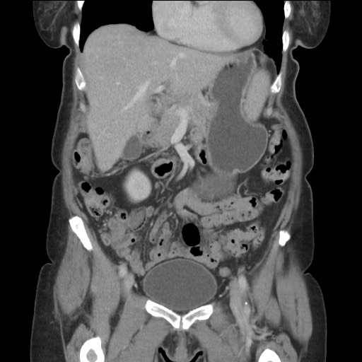 Bilateral adrenal granulocytic sarcomas (chloromas) (Radiopaedia 78375-91007 B 35).jpg