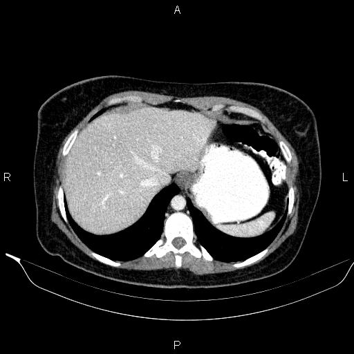 File:Bilateral adrenal myelolipoma (Radiopaedia 63058-71535 B 23).jpg