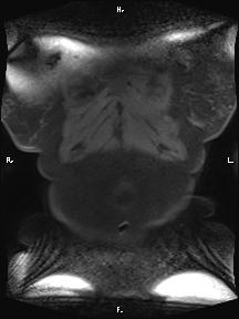 Bilateral adrenal myelolipoma (Radiopaedia 63058-71537 Coronal T1 fat sat 103).jpg