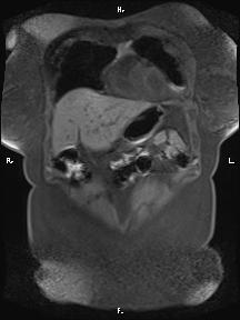 Bilateral adrenal myelolipoma (Radiopaedia 63058-71537 Coronal T1 fat sat 88).jpg