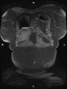 Bilateral adrenal myelolipoma (Radiopaedia 63058-71537 Coronal T1 fat sat 99).jpg