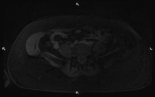 Bilateral adrenal myelolipoma (Radiopaedia 63058-71537 G 80).jpg