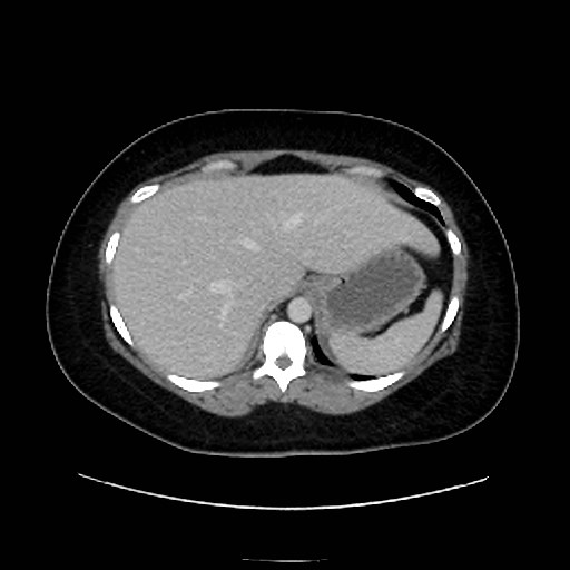 Bilateral adrenal thrombosis (Radiopaedia 58182-65256 A 10).jpg