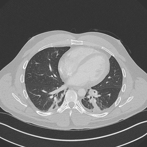 Bilateral atelectasis (Radiopaedia 48666-53675 Axial lung window 71).jpg