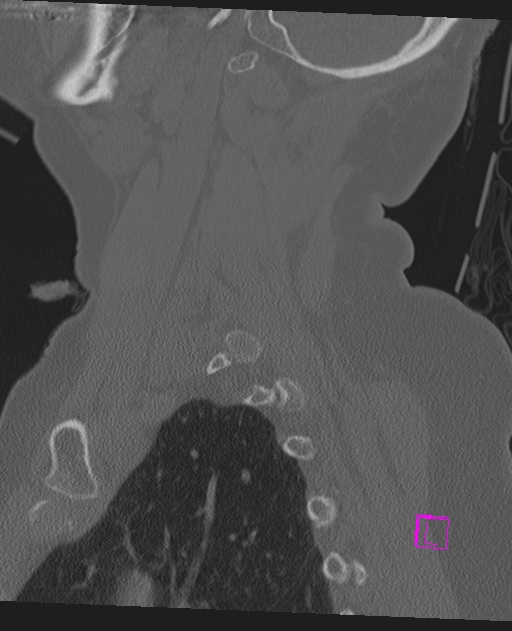 Bilateral atlanto-occipital assimilation (Radiopaedia 28350-28603 Sagittal bone window 62).jpg