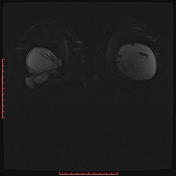 File:Bilateral breast implant rupture (Radiopaedia 24761-25027 PASTA Si IR 10).jpg