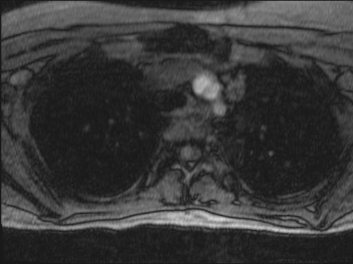 Bilateral carotid body tumors and right glomus jugulare tumor (Radiopaedia 20024-20060 Axial MRA 157).jpg