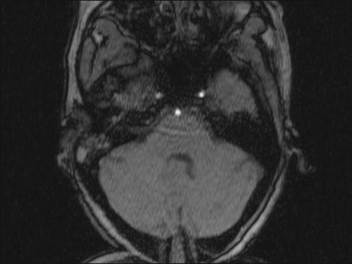 Bilateral carotid body tumors and right glomus jugulare tumor (Radiopaedia 20024-20060 Axial MRA 320).jpg