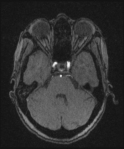Bilateral carotid body tumors and right glomus jugulare tumor (Radiopaedia 20024-20060 Axial MRA 55).jpg