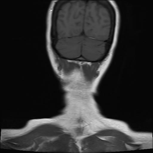 File:Bilateral carotid body tumors and right jugular paraganglioma (Radiopaedia 20024-20060 Coronal 25).jpg