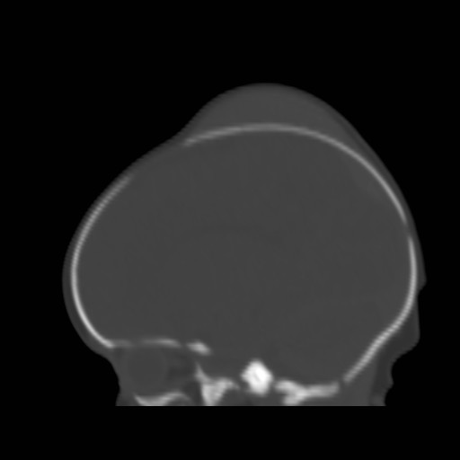 File:Bilateral cephalohematomas and subdural hematomas (Radiopaedia 26778-26929 Sagittal bone window 27).jpg