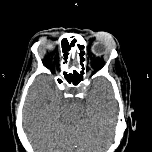 File:Bilateral enlargement of lacrimal glands - sarcoidosis (Radiopaedia 62627-70921 Axial non-contrast 53).jpg