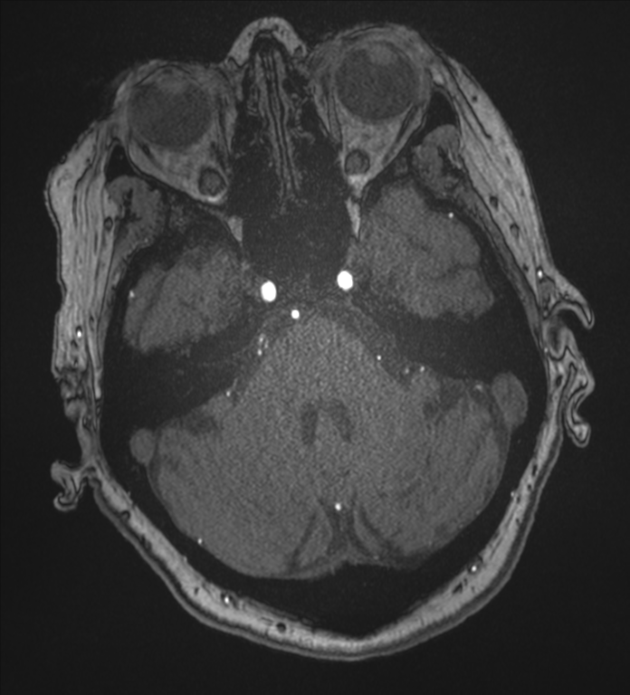 Bilateral fetal posterior communicating arteries (Radiopaedia 41286-44102 Axial MRA 47).png