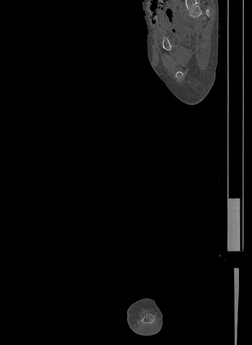 Bilateral fibular hemimelia type II (Radiopaedia 69581-79491 Sagittal bone window 39).jpg