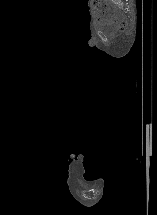 Bilateral fibular hemimelia type II (Radiopaedia 69581-79491 Sagittal bone window 44).jpg