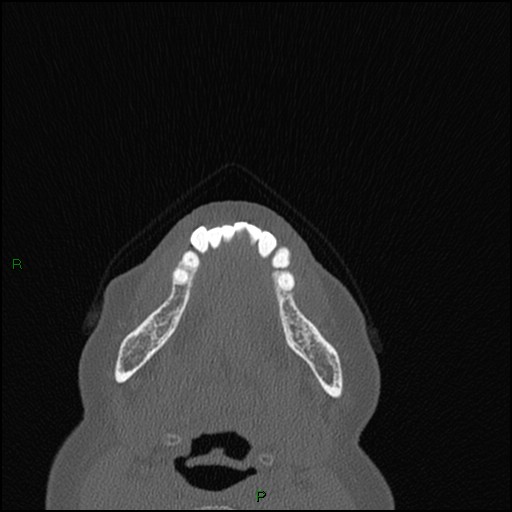 Bilateral frontal mucoceles (Radiopaedia 82352-96454 Axial bone window 309).jpg