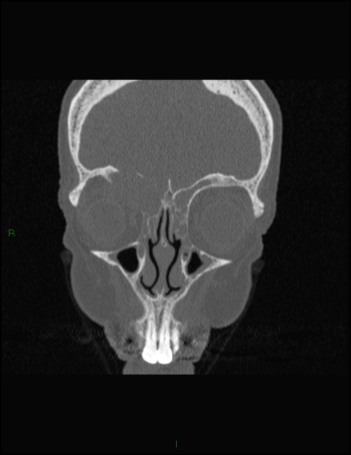 Bilateral frontal mucoceles (Radiopaedia 82352-96454 Coronal 101).jpg