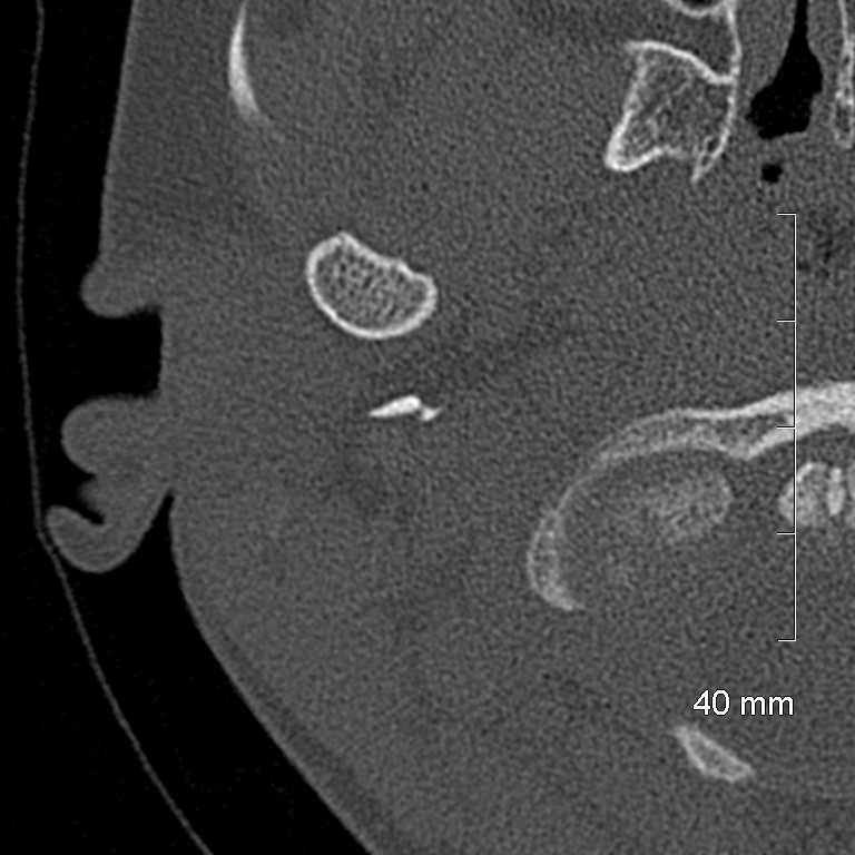 Bilateral grommets (Radiopaedia 47710-52404 Axial bone window 2).jpg