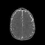 File:Bilateral mesial temporal polymicrogyria (Radiopaedia 76456-88181 Axial ADC 19).jpg