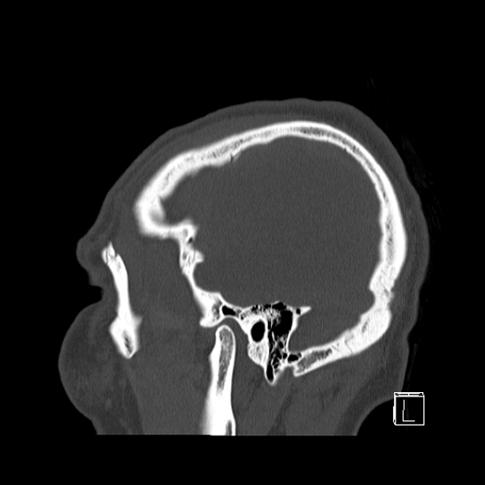Bilateral occipital condyle fracture (type 2) (Radiopaedia 87675-104089 Sagittal bone window 102).jpg